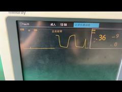 Ein genauerer Blick: Mindray-Wasserabscheider für das Anästhesiegasmodul 9200-10-10530 für Erwachsene und Kinder